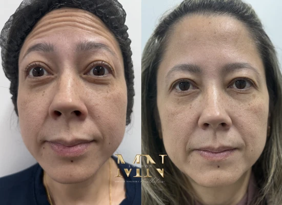 anti-wrinkle-treatment-london (1)