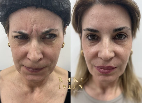 anti-wrinkle-treatment-london (2)