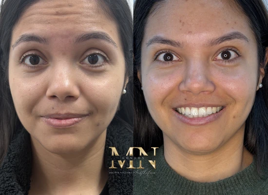 anti-wrinkle-treatment-london (3)