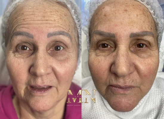 anti-wrinkle-treatment-london (4)