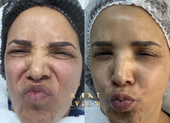anti-wrinkle-treatment-london (5)