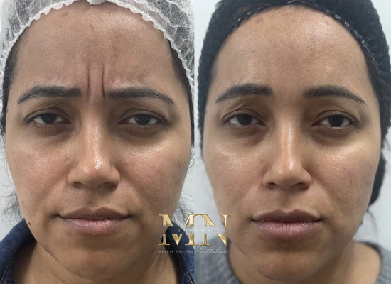 anti-wrinkle-treatment-london (6)