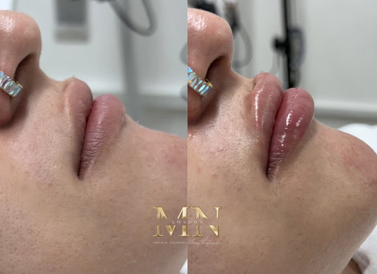 lip-filler-before-and-after-london (1)