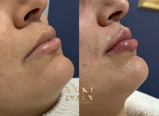 lip-filler-before-and-after-london (2)