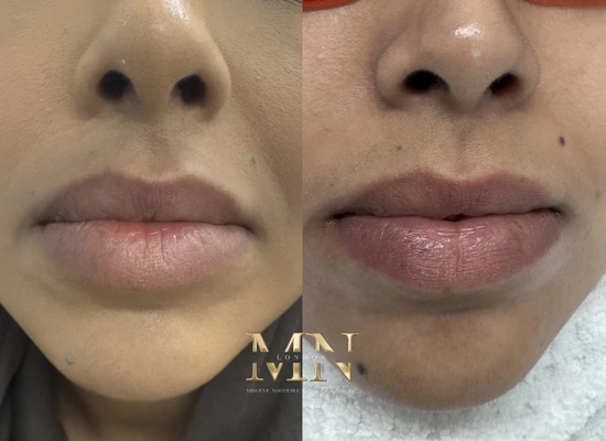 lip-filler-before-and-after-london (3)