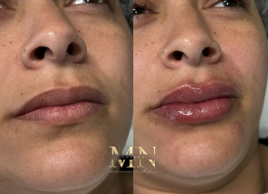 lip-filler-before-and-after-london (4)