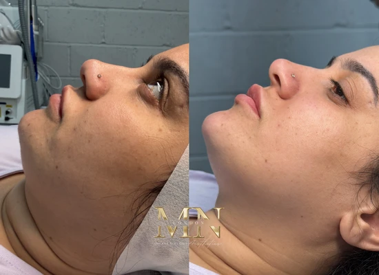 ultraformer-treatment-london (1)