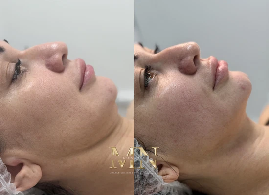 ultraformer-treatment-london (2)