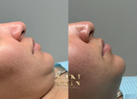 ultraformer-treatment-london (3)