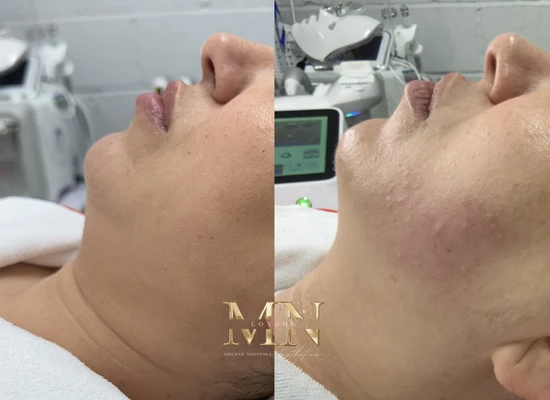 ultraformer-treatment-london (4)