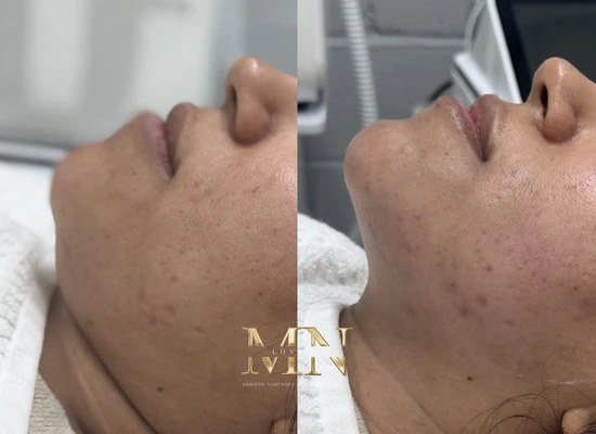 ultraformer-treatment-london (5)